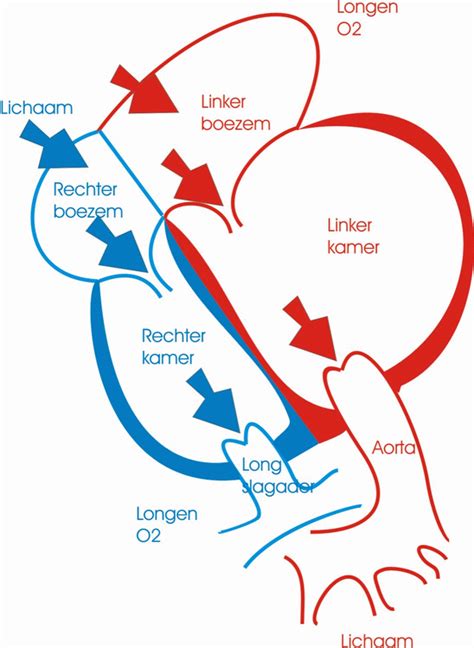 Gedilateerde Cardiomyopathie .